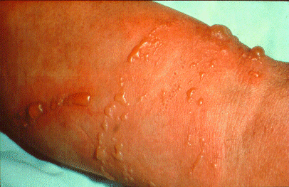 SLIDE 123 - Ethylene Oxide Dermatitis