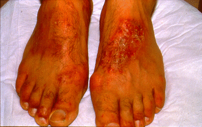 SLIDE 127 - Allergic Shoe or Work Boot Dermatitis