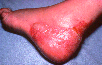 Slide 129 - Shoe Dermatitis