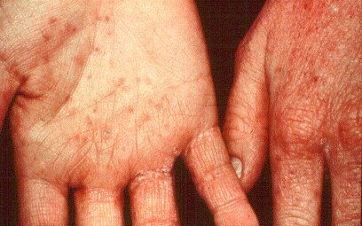 SLIDE 133 - Contact Urticaria Syndrome to Raw Fish